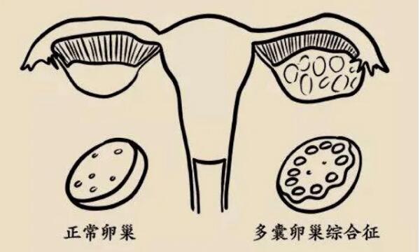 多囊卵巢综合症能吃豆皮吗？什么东西不能吃？